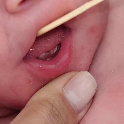 Bebê nasce com dois dentes e surpreende família e equipe médica em Brumado