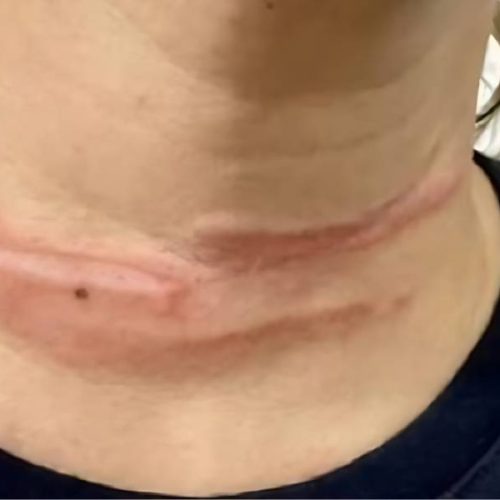 Fio solto provoca acidente e quase causa tragédia em Livramento de Nossa Senhora