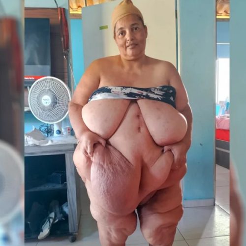 Moradora de Itambé luta por cirurgia reparadora após bariátrica: “Só quero viver sem dor”