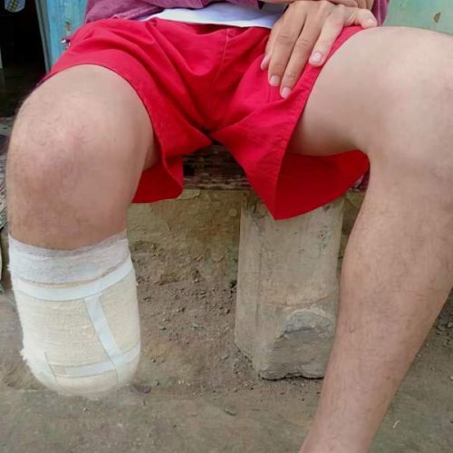 Pé de servidor que amputou o próprio membro para tentar fraude milionária foi achado em mochila