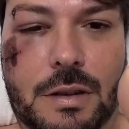 Prefeito de Encruzilhada sofre acidente de bicicleta e passará por cirurgia