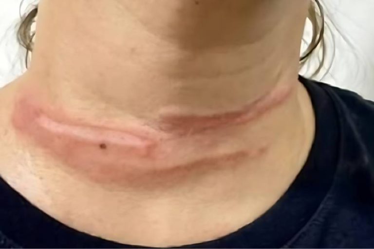 Fio solto provoca acidente e quase causa tragédia em Livramento de Nossa Senhora