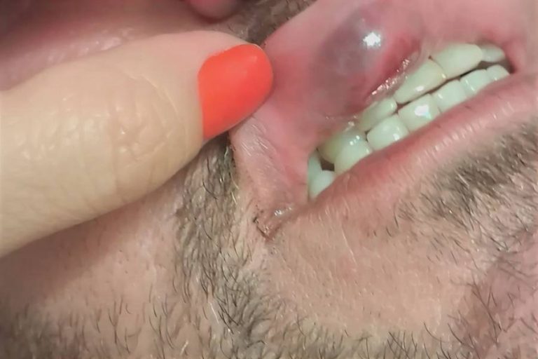 Folião denuncia agressão de guarda municipal em Brumado, Prefeitura apura o caso