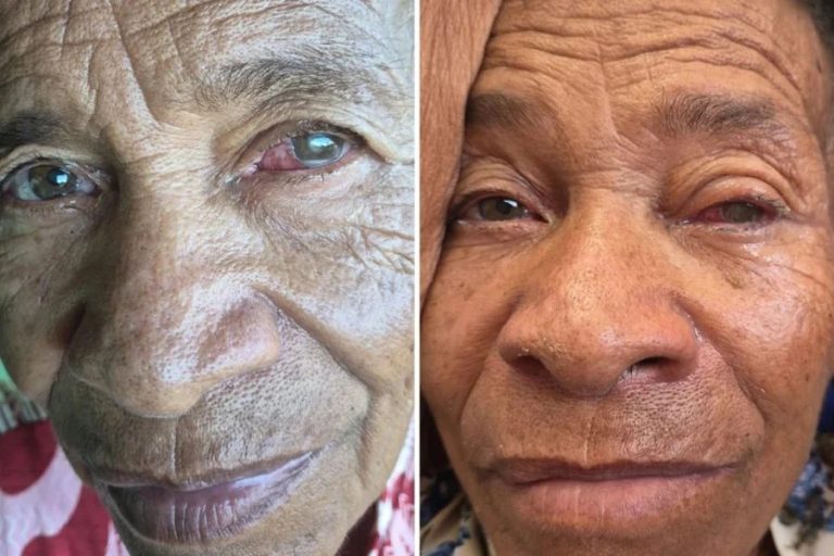 Mutirão deixa pacientes cegos na Bahia e caso vira escândalo de saúde