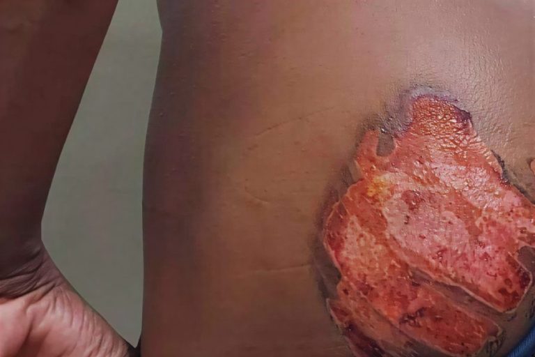 Polícia prende suspeitos de tortura contra jovem com deficiência em Livramento