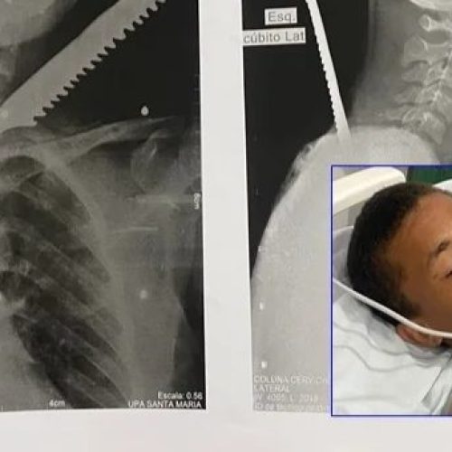 Homem é internado com faca cravada na clavícula após ataque em São Félix do Coribe