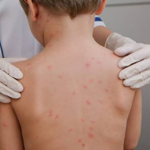 Casos de meningites coloca em de alerta Vitória da Conquista e região